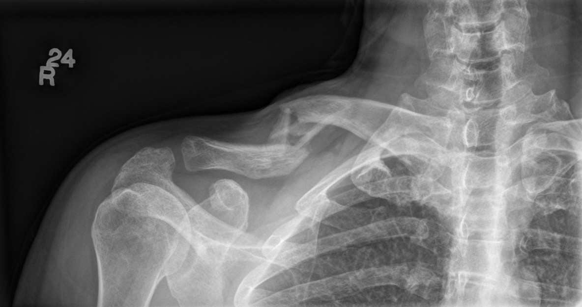Clavicle%20(1184%20x%20626).jpg